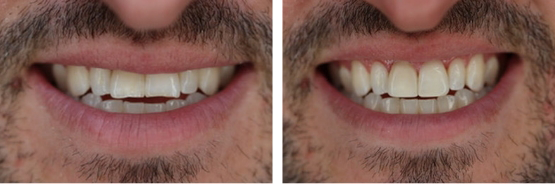 Close-up of smile with damaged teeth before and after veneers