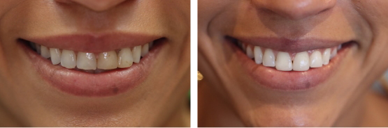 Smile with discolored teeth before and after veneers