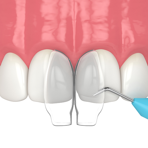 Illustration of the cosmetic bonding process