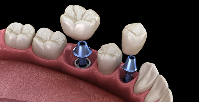 Two dental crowns being attached to dental implants in Greenwood Village