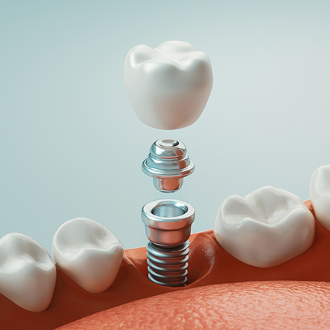 Illustration of dental implant, abutment, and crown being inserted into jaw