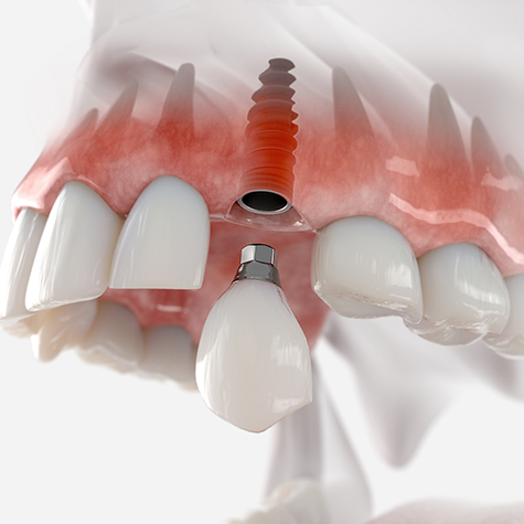 Illustration of a crown being attached to dental implant in upper jaw