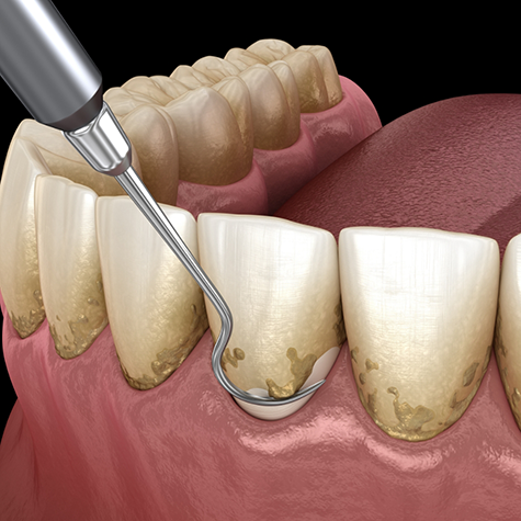 Illustration of scaling and root planing being carried out on teeth in lower arch