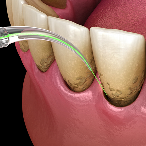 Illustration of green laser being used to treat gums