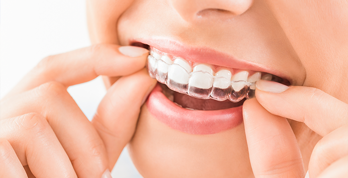 Patient putting in a clear aligner