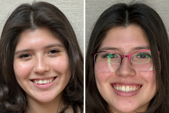 Female patient with long black hair before and after Invisalign