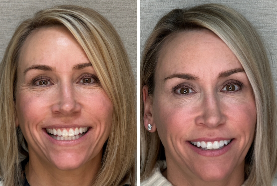 Blonde female patient before and after Invisalign