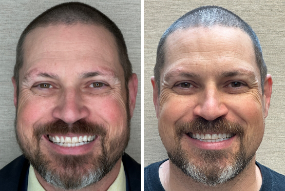 Bearded male patient with shaved hair before and after Invisalign