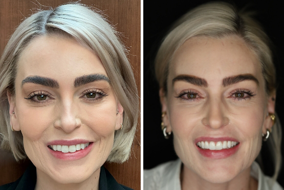 Woman with short blonde hair before and after Invisalign