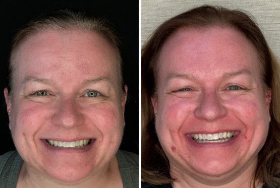 Older woman with dark hair before and after Invisalign