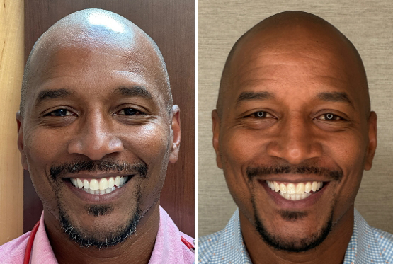 Bearded bald man before and after Invisalign