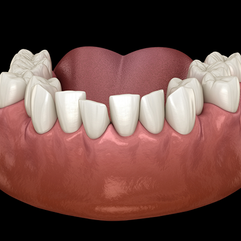 Illustration of bottom arch with multiple misaligned teeth