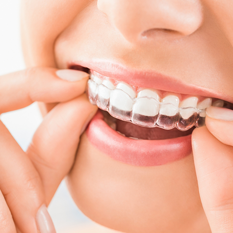 Woman putting Invisalign aligner over upper teeth