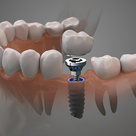 Illustration of crown and abutment being attached to dental implant