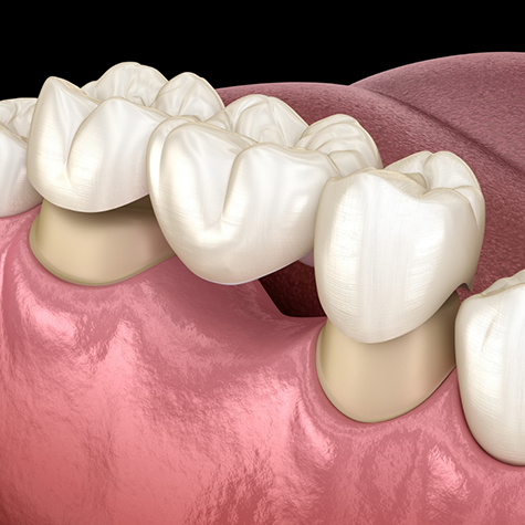 Illustration of dental bridge being attached to two teeth