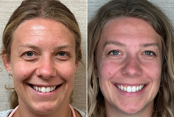 Blonde female patient before and after Invisalign