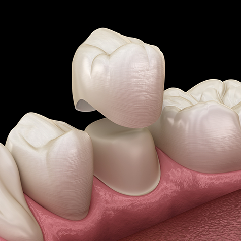 Illustration of dental crown being placed on tooth