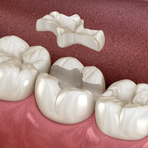 Illustration of inlay being placed on tooth