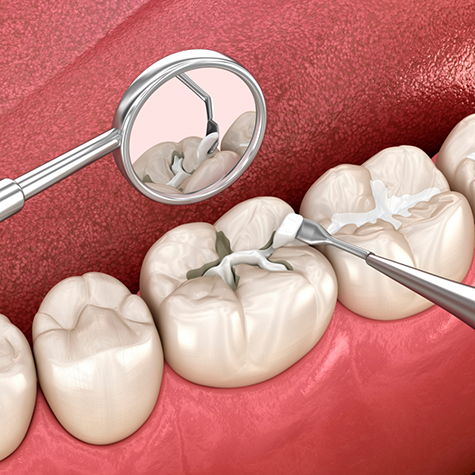 Illustration of tooth receiving tooth-colored filling