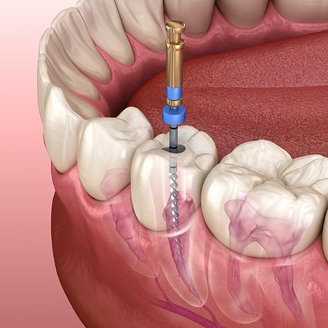 Illustration of root canal treatment in Greenwood Village being performed