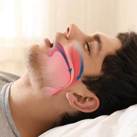 Diagram of man with sleep apnea in Greenwood Village