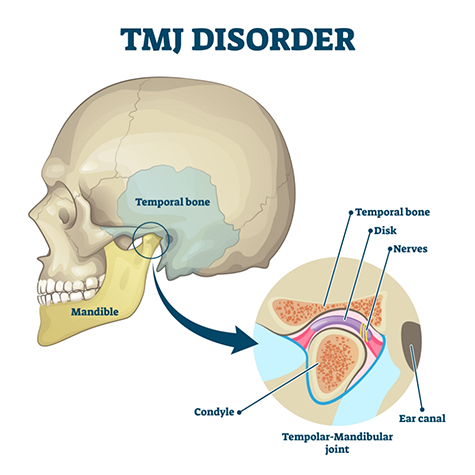 Illustration of skull with temporomandibular joint highlighted