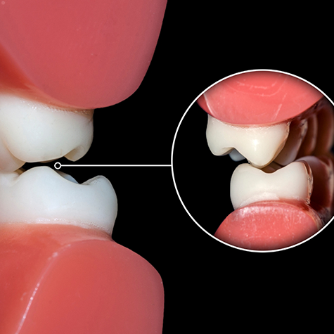 Close-up of teeth showing how they come together