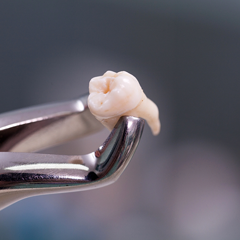 Forceps holding tooth after a tooth extraction