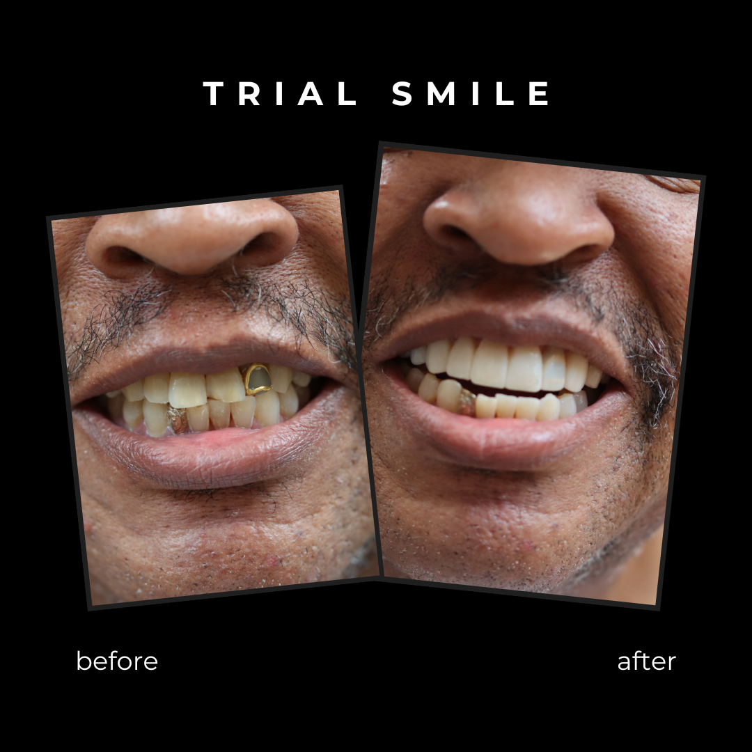 Pictures of patient's teeth before and after having veneers placed