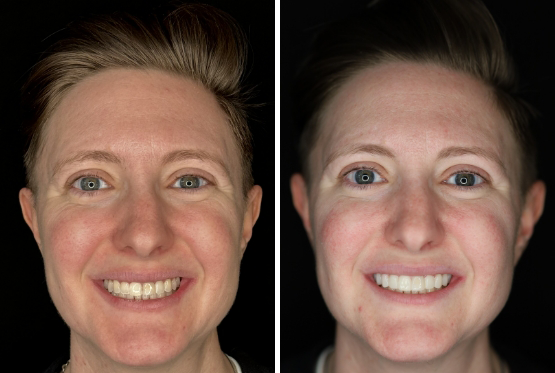 Woman with combed back hair before and after her trial smile