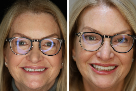 Blonde woman with glasses before and after her trial smile