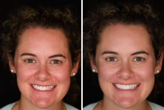 Brown haired woman with earrings before and after her trial smile