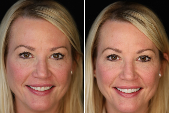 Woman with parted blonde hair before and after her trial smile