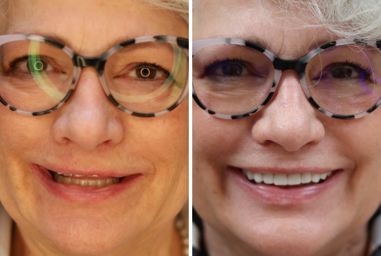 Close-up of woman with glasses before and after trial smile