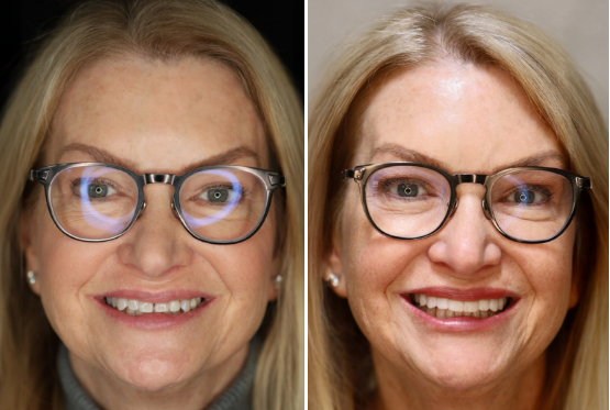 Blonde patient with glasses before and after veneers