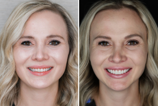 Woman with wavy blonde hair before and after veneers