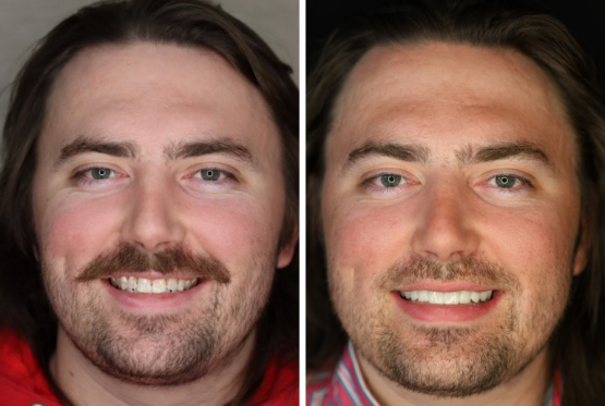 Man with mustache before and after veneers