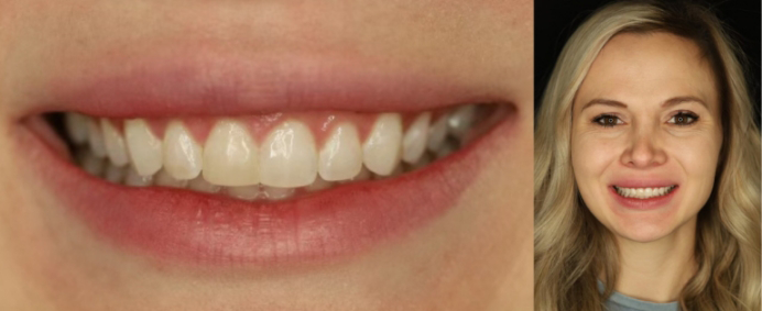 Close-up of patient's smile at their first appointment