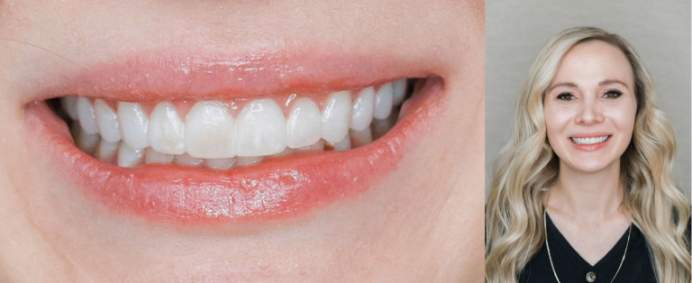 Close-up of patient's smile after receiving temporary veneers