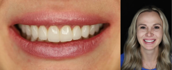 Close-up of patient's smile after permanent veneers have been placed