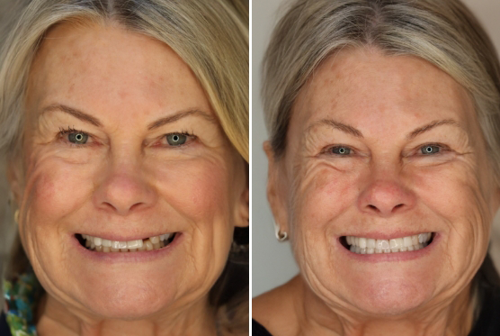 Senior woman before and after veneers