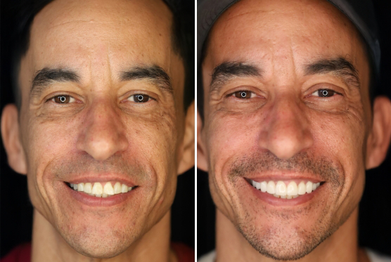 Male patient before and after veneers