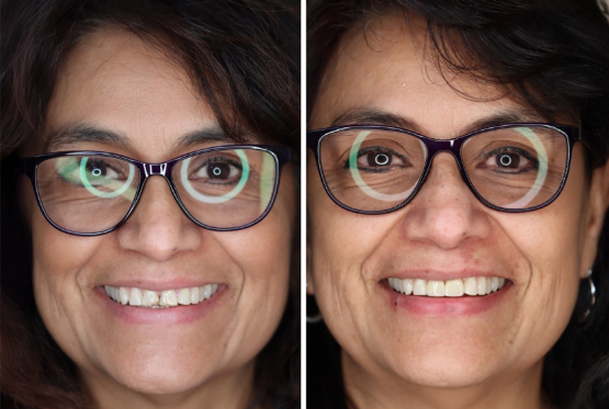 Patient with glasses before and after veneers