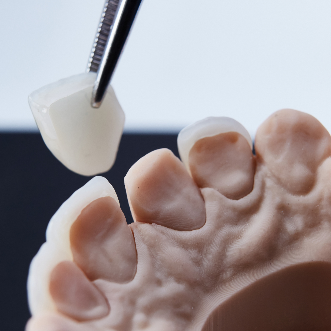 Veneer being carefully lifted off impression of teeth